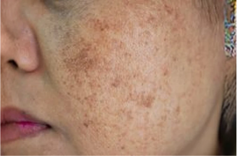 Pigmentation Triggers